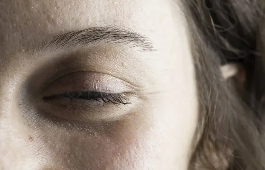 Ptosis Surgery