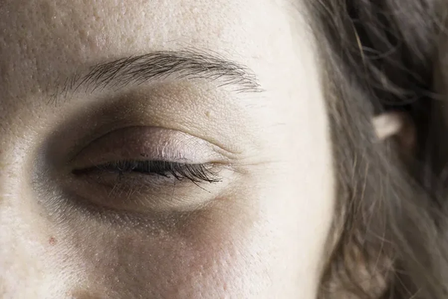 Ptosis Surgery