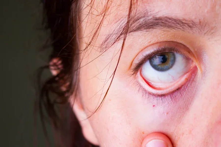 Ptosis Surgery